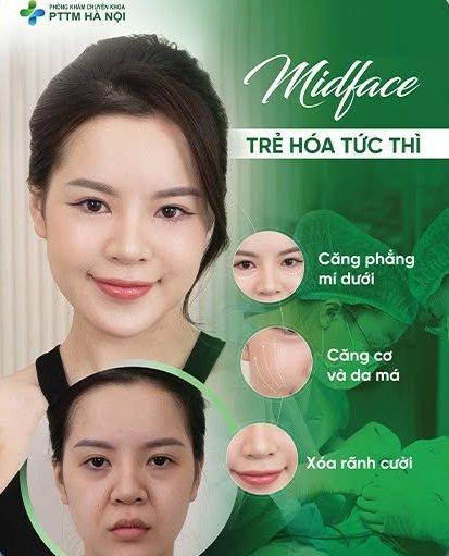 Ấn phẩm Midface trẻ hóa cho Phòng khám PTTM Hà Nội